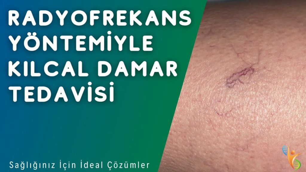 ameliyatsız varis tedavisi