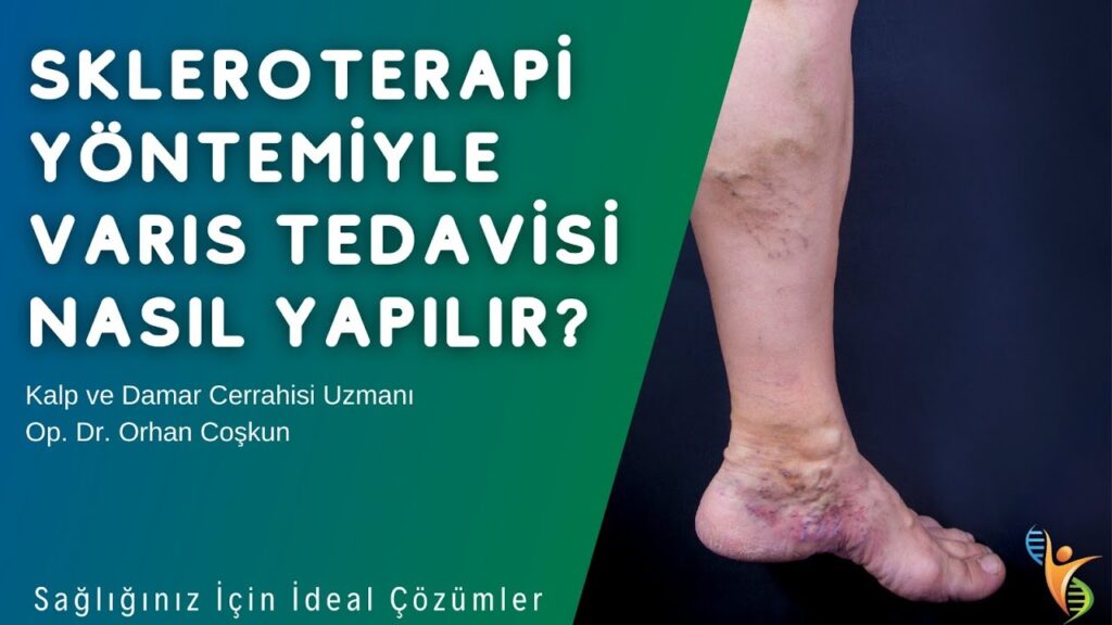 Ameliyatsız Varis Tedavi Yöntemleri Güncel Bilgiler